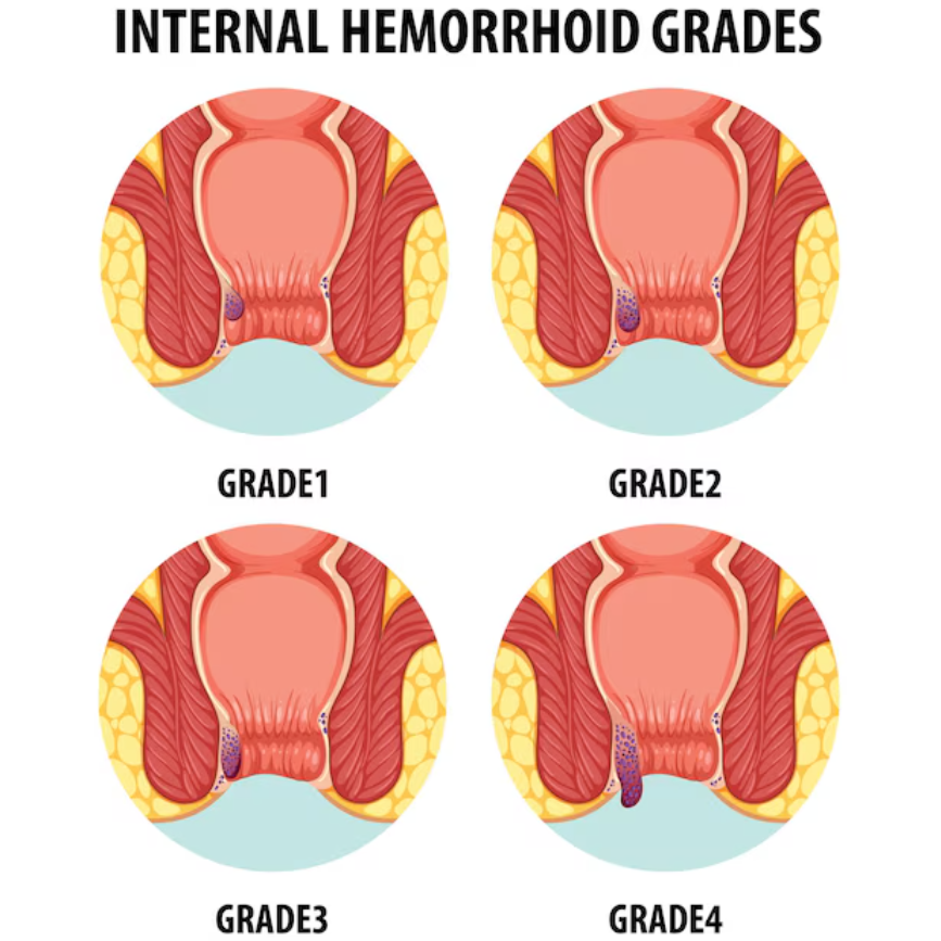Piles and Haemorrhoids Treatment in Chennai main image