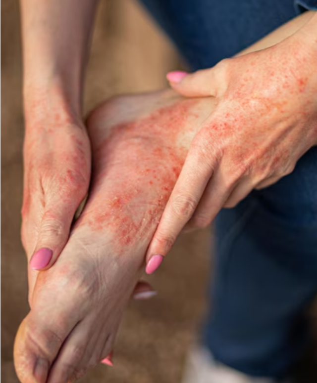 Psoriasis Ayurvedic Treatment in Pune – Healing from the Root Cause main image