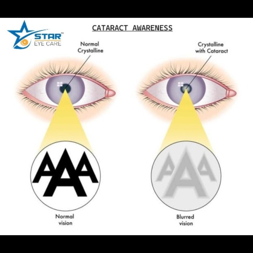 CATARACT AWARENESS ! main image