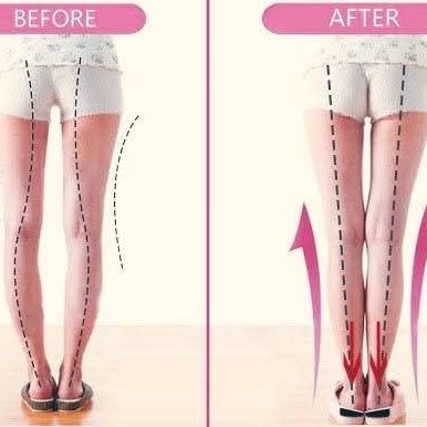 Bowlegs in adults treatment at Sunshine clinic main image