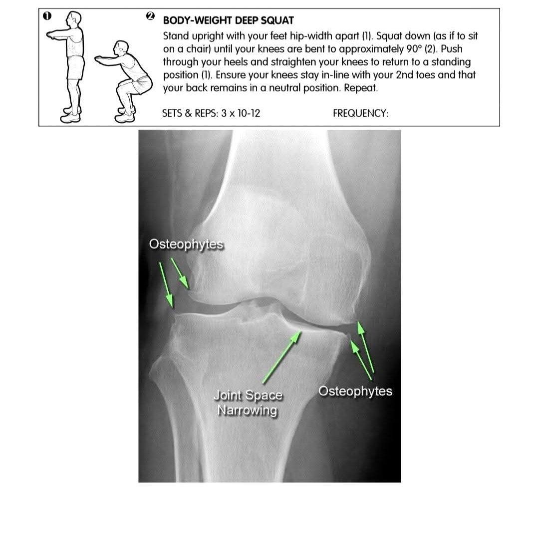 Knee Osteoarthritis Treatment at Sunshine clinic main image