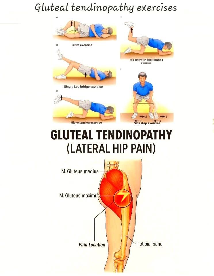 Gluteal tendinopathy Treatment at Sunshine Super Speciality Physiotherapy Clinic main image