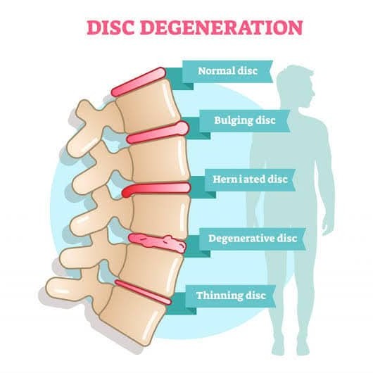 Difference: 🗒️Bulging disc and Herniated disc???

and Physiotherapy Treatment at Sunshine Clinic main image