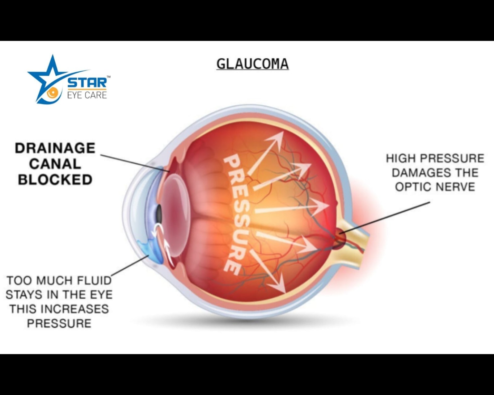 GLAUCOMA. main image