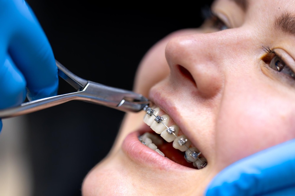 Braces treatment in Delhi – a trusted option still today main image