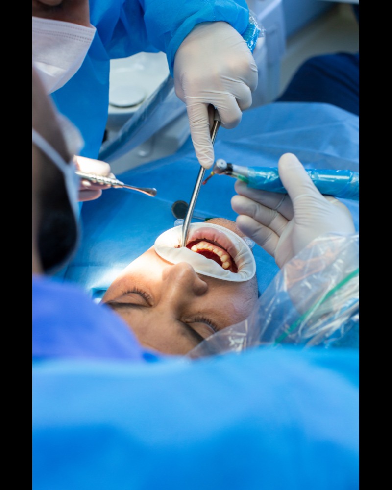 Apicoectomy in Delhi – Saving a tooth that might be lost main image