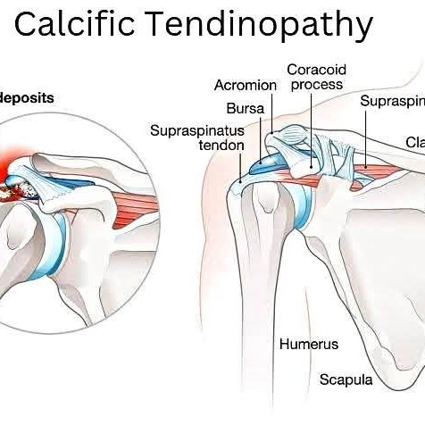Calcific Tendinopathy of the Shoulder treatment at Sunshine clinic main image