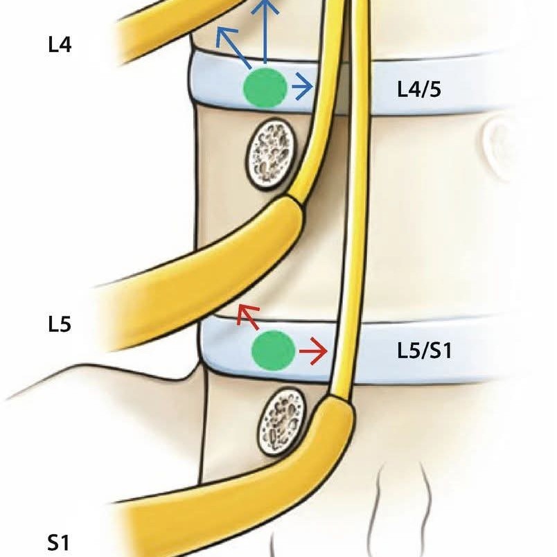 lumbar nerve roots are only tangentially affected by intervertebral discs in the segments L4/L5 main image
