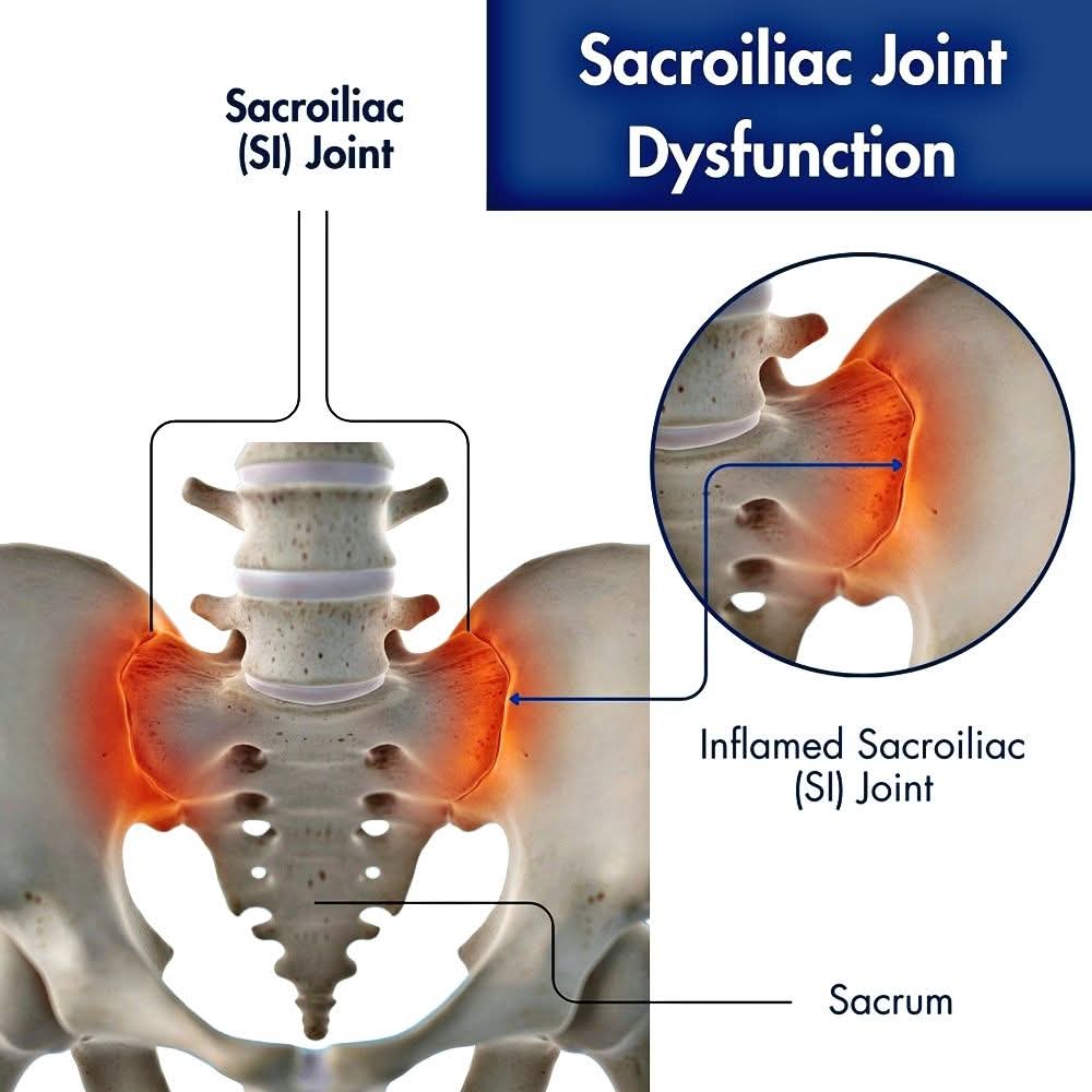 Management of sacroiliac joint pain: current concepts main image