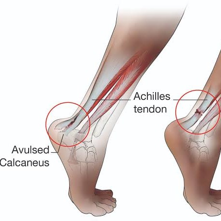 Achilles Tendon Rupture and Treatment at Sunshine Clinic main image