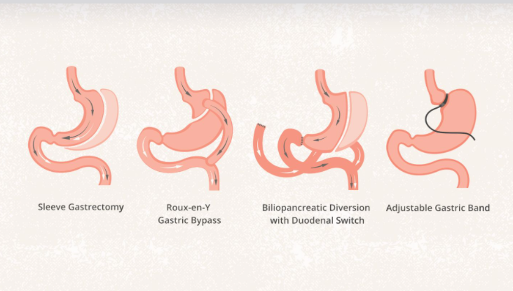 Bariatric Surgery in Rasta Peth – A Life-Changing Step Toward Health main image