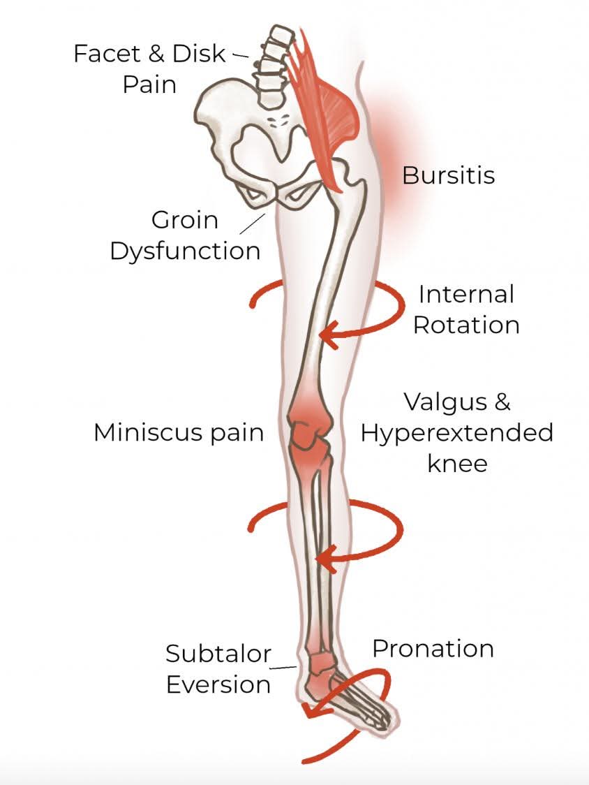 Pronation Distortion Syndrome (PDS) Treatment at Sunshine Clinic main image
