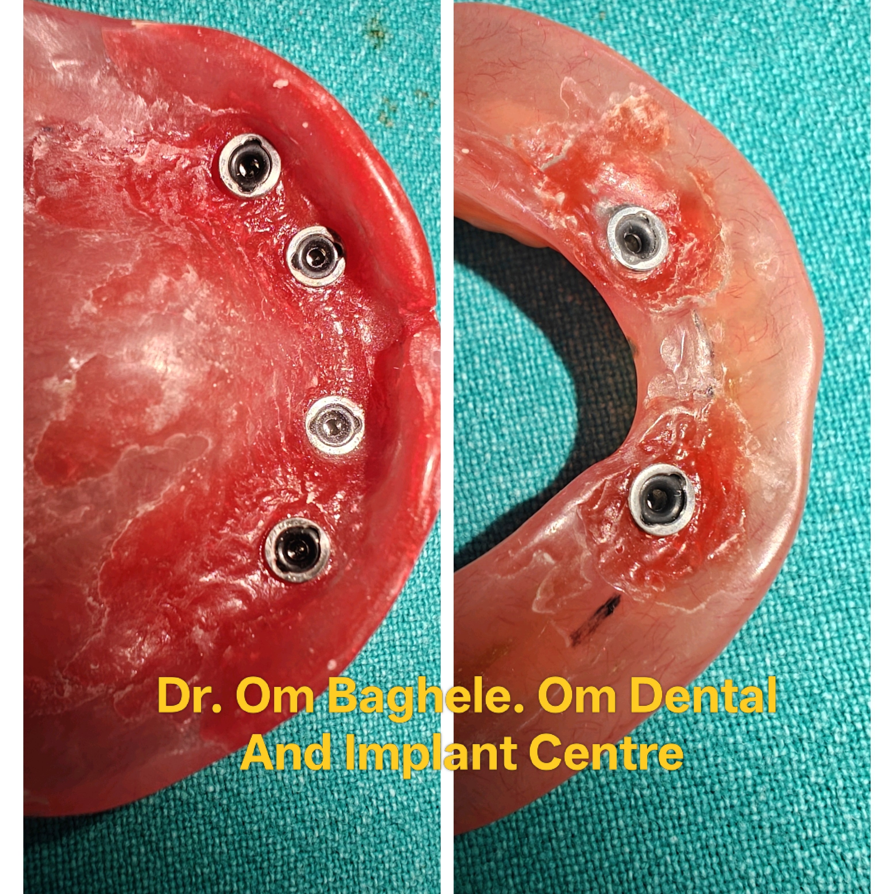 Implant Supported Dentures main image