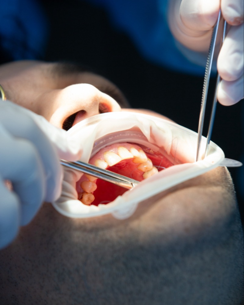 Pulpotomy in Delhi – Preserving part of the tooth pulp main image