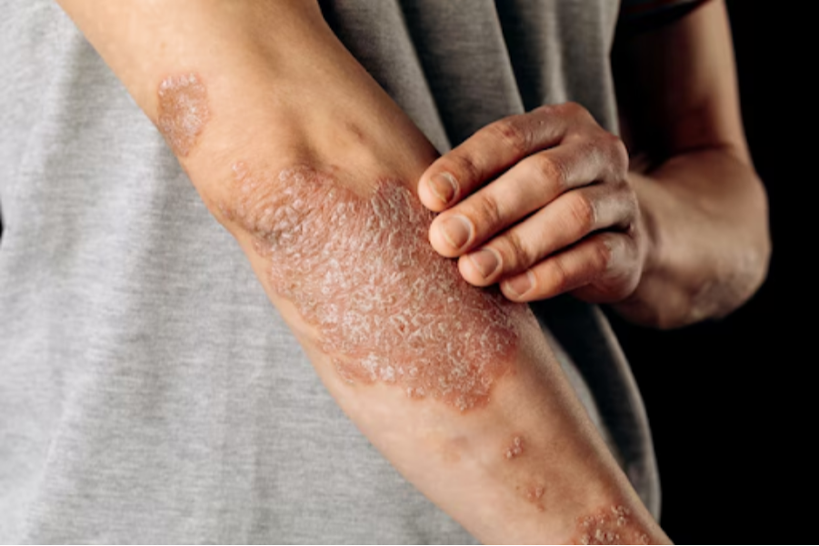 Best Medicine for Psoriasis in Ayurveda in Pune – Natural Relief for Lasting Comfort main image