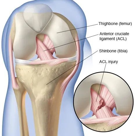Anterior Cruciate Ligament (ACL)

(Structure, Injuries, and Management)

at Sunshine clinic main image