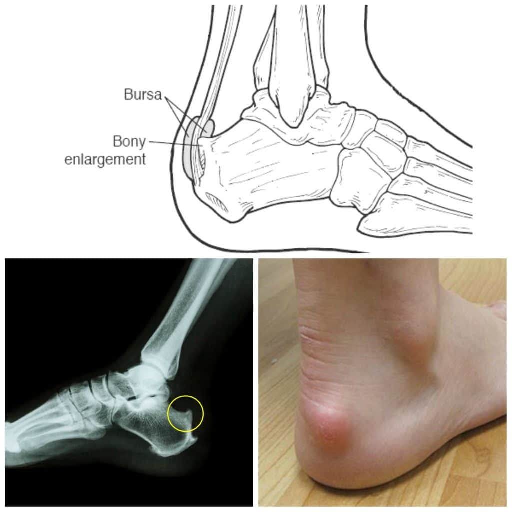 Haglund's Deformity: Understanding the 