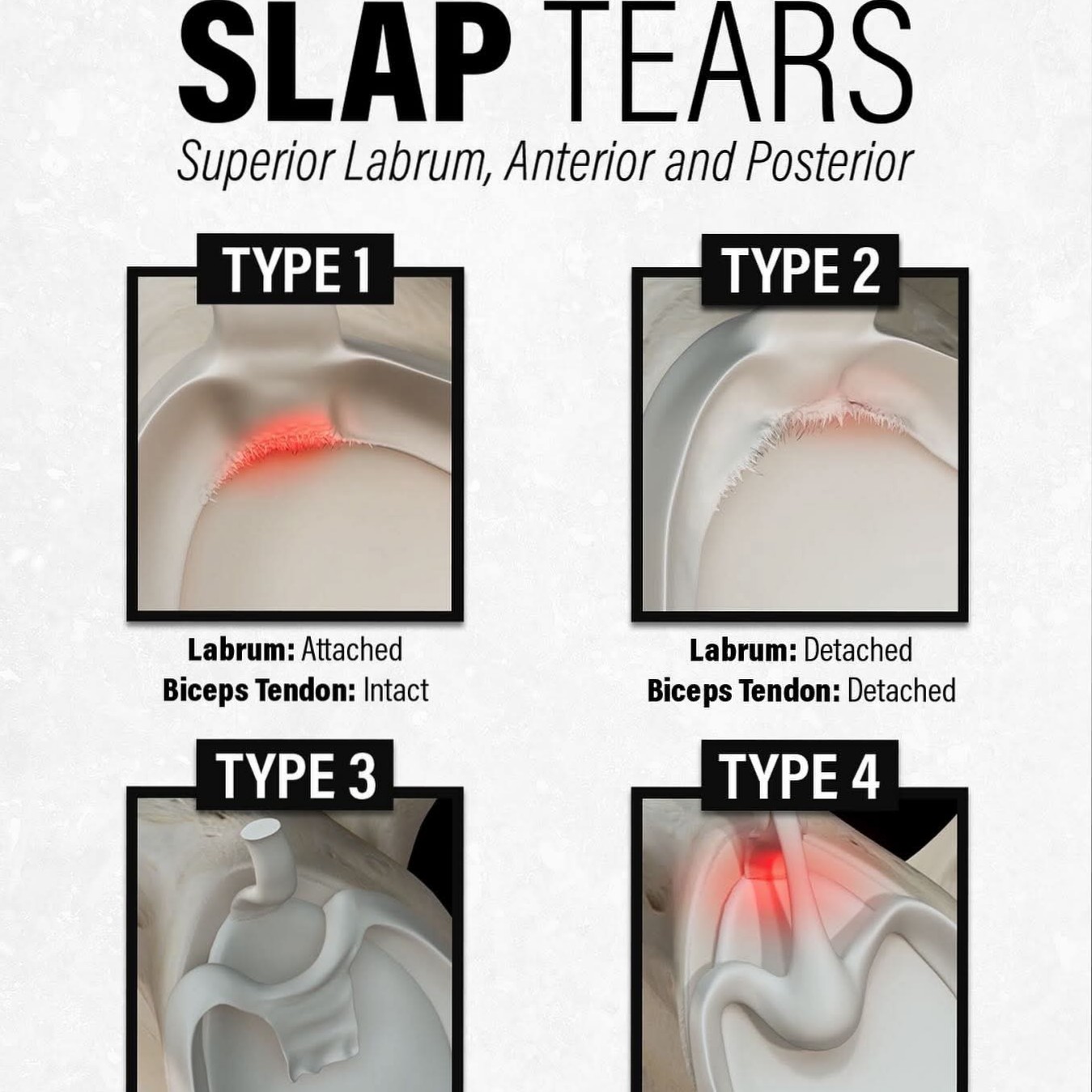 SLAP Tear Treatment at Sunshine Clinic main image