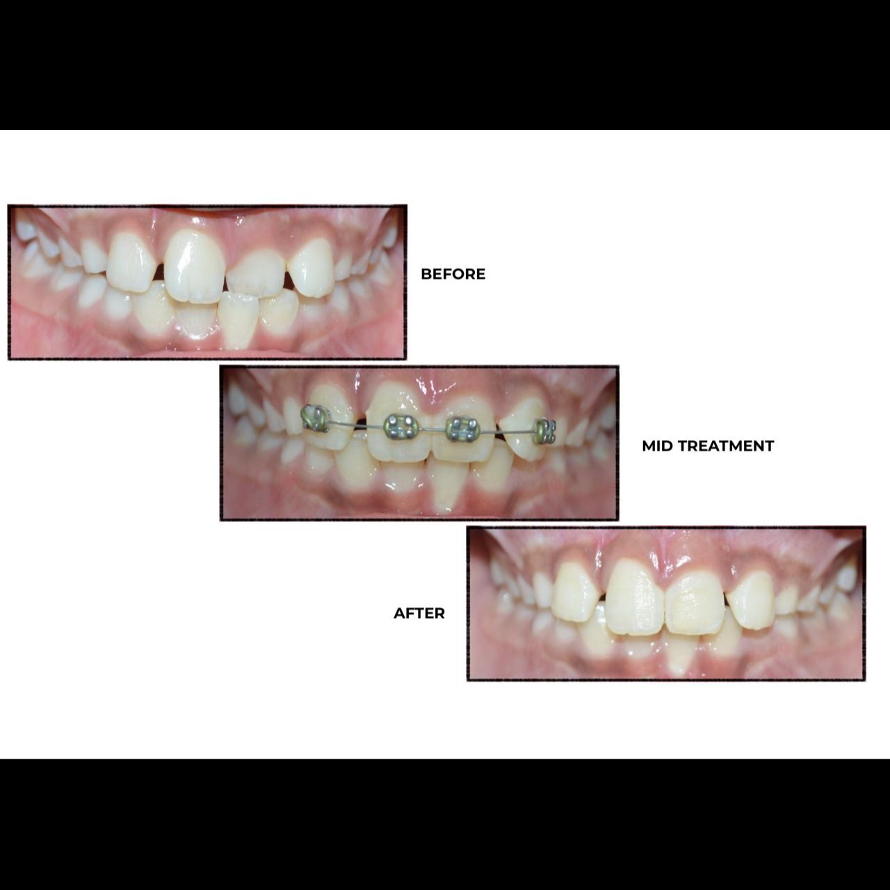 Single tooth crossbite corrected.
Braces not only align teeth but also balance your bite. Many other... main image