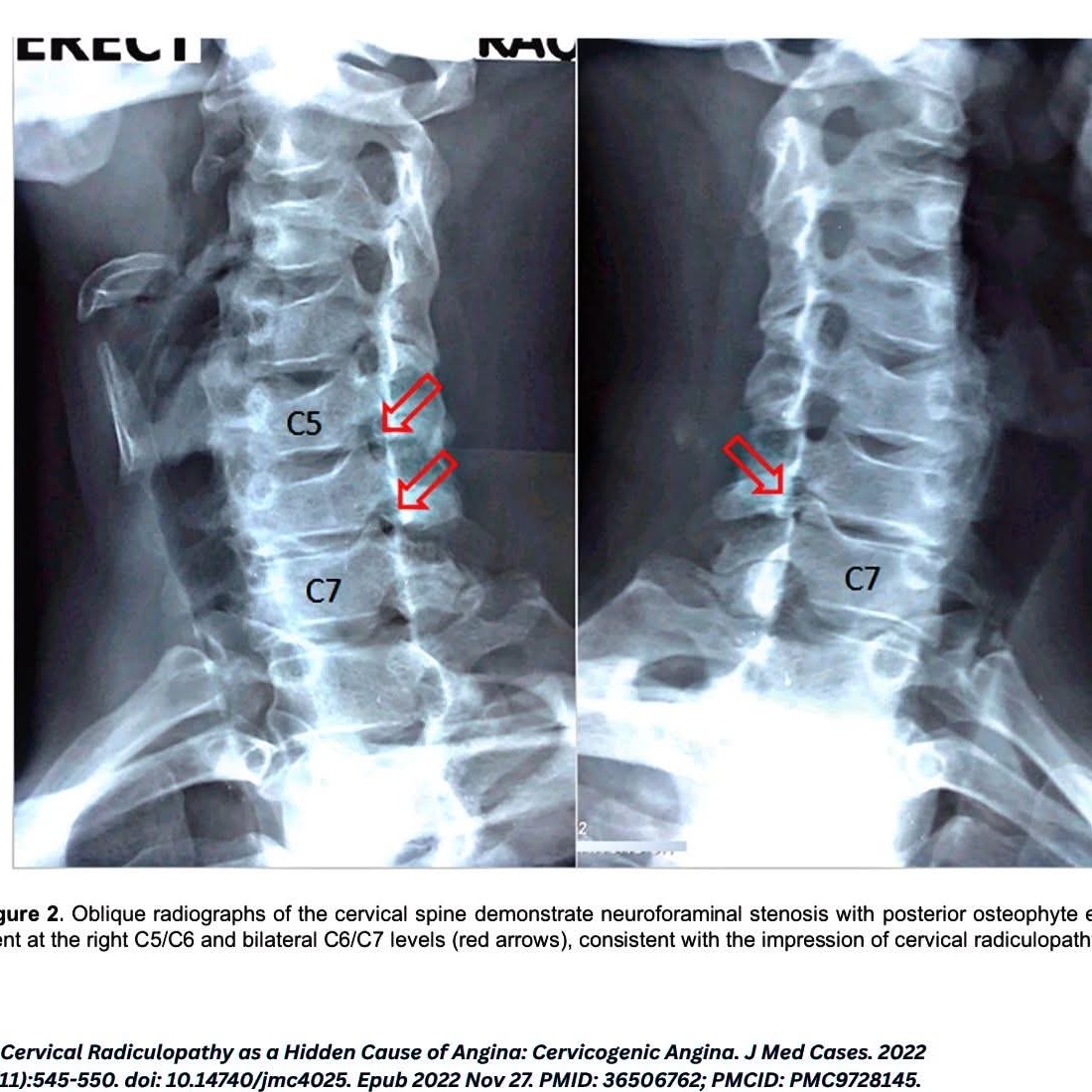Cervicogenic Angina (CA): When Chest Pain Hides in the Neck main image