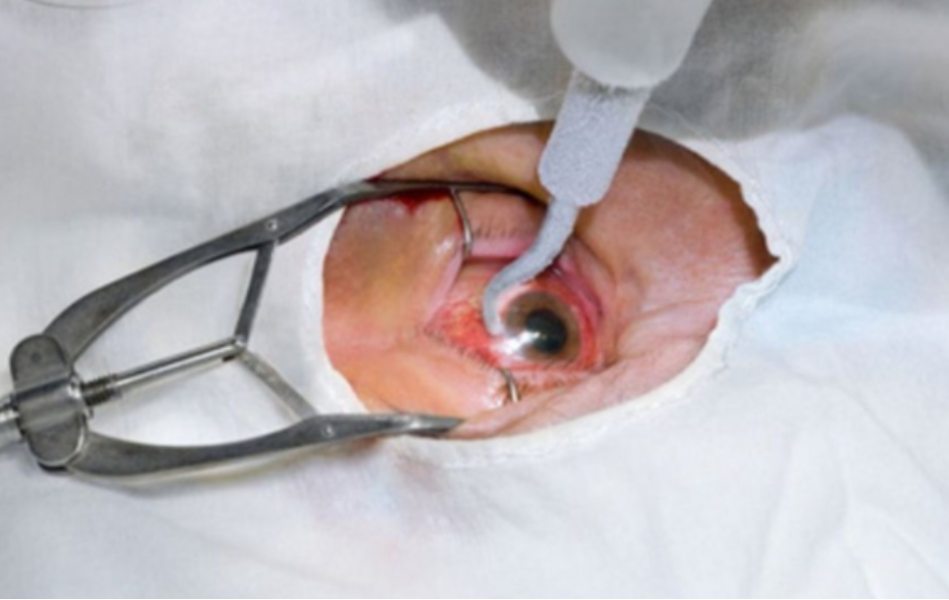 Phacoemulsification in Nagpur – Modern Cataract Removal Technique main image