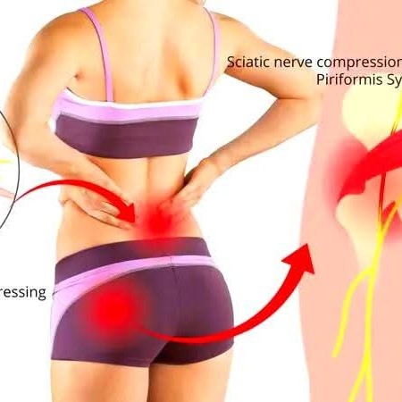 Sciatica Treatment at Sunshine Clinic main image