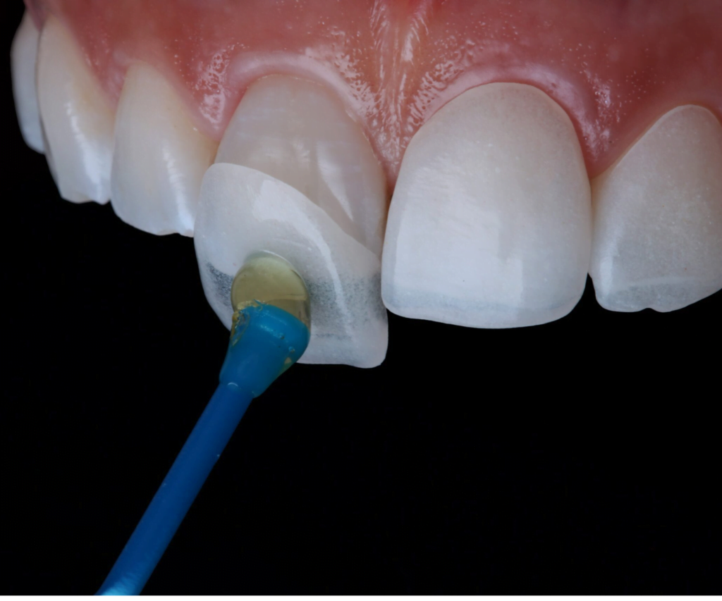 Dental Veneers in Mahim, Dadar & Bandra main image