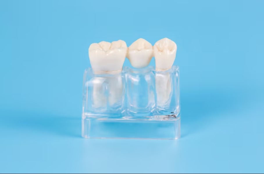  Glass Ceramic Crowns in Delhi – Beauty with Strength main image