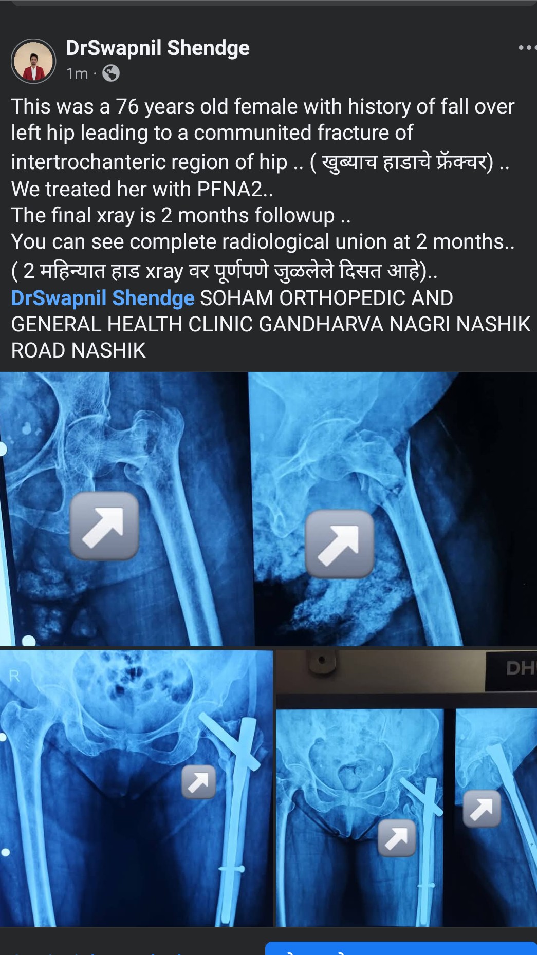 A tale of fracture union within 2 months.. treated by our surgeon Dr. Swapnil Shendge  main image