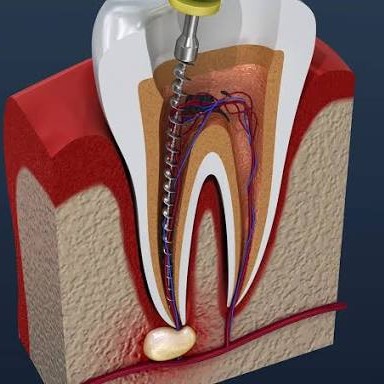 Root Canal Treatment in Mahim – Save Your Natural Tooth with Expert Care main image