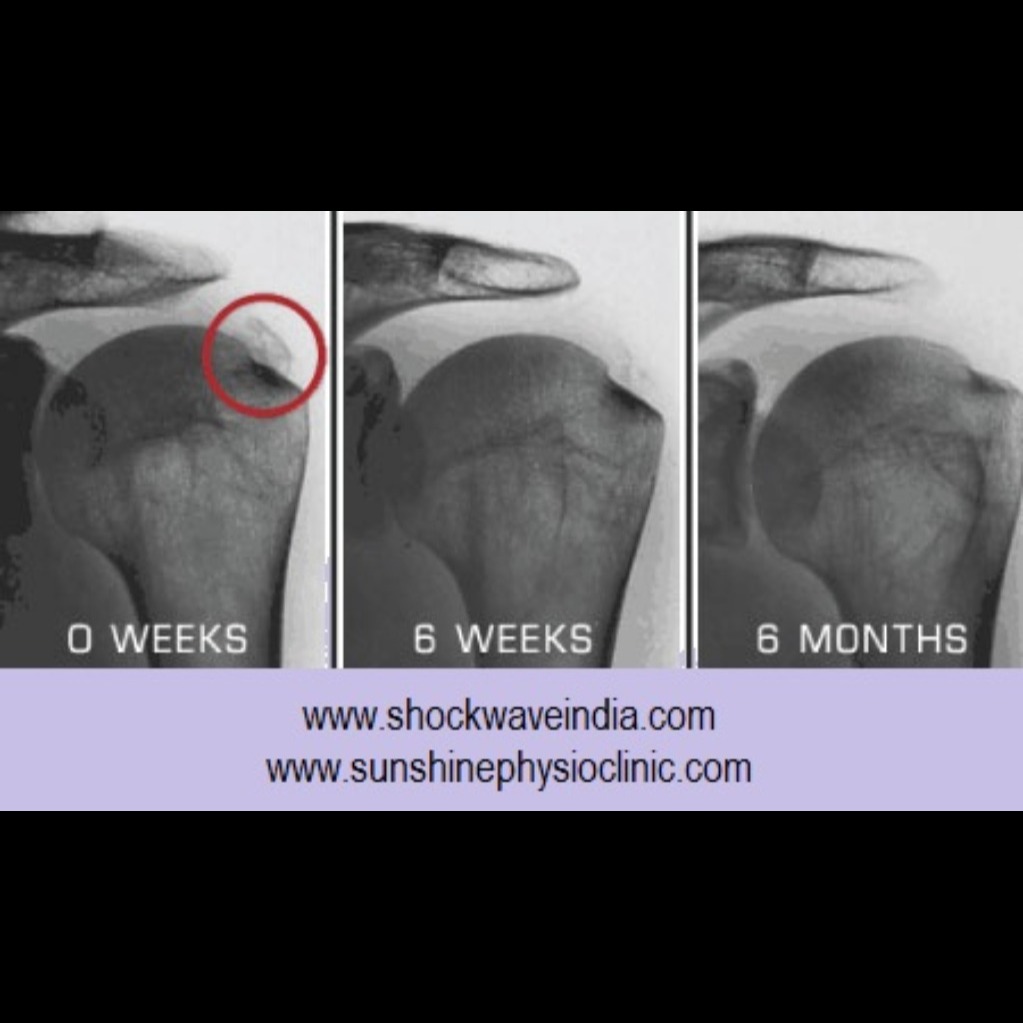 Calcific Tendinopathy of the Shoulder Treatment at Sunshine Clinic main image