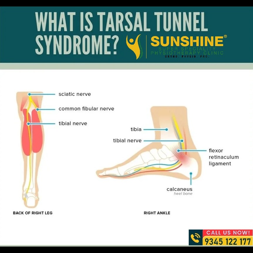 Tarsal Tunnel Syndrome (TTS) Treatment at Sunshine Super Speciality Physiotherapy Clinic main image
