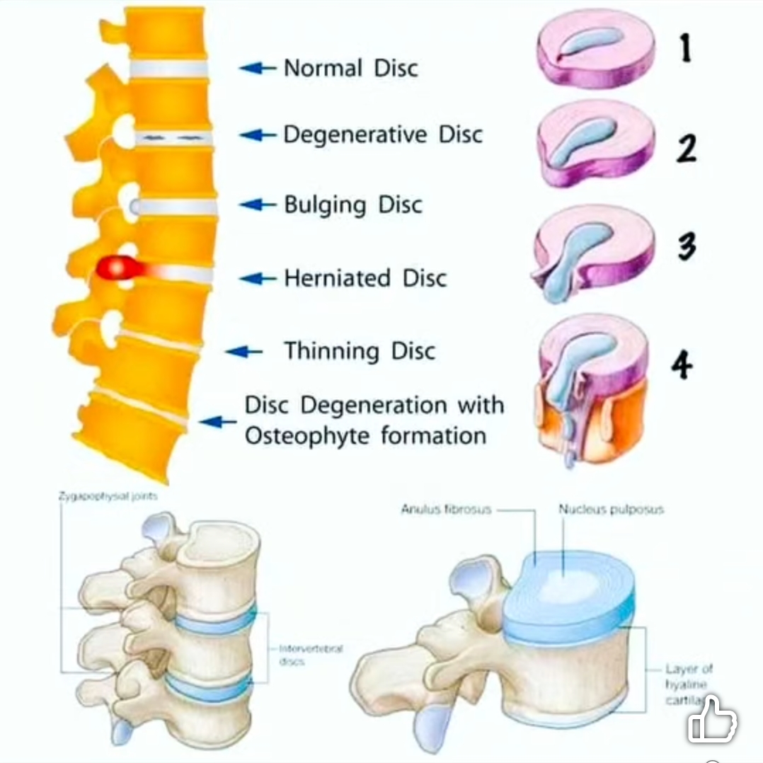 Disc Bulge, Herniated Disc, Disc Prolapse, and Disc Sequestration – Causes and Physiotherapy Treat main image