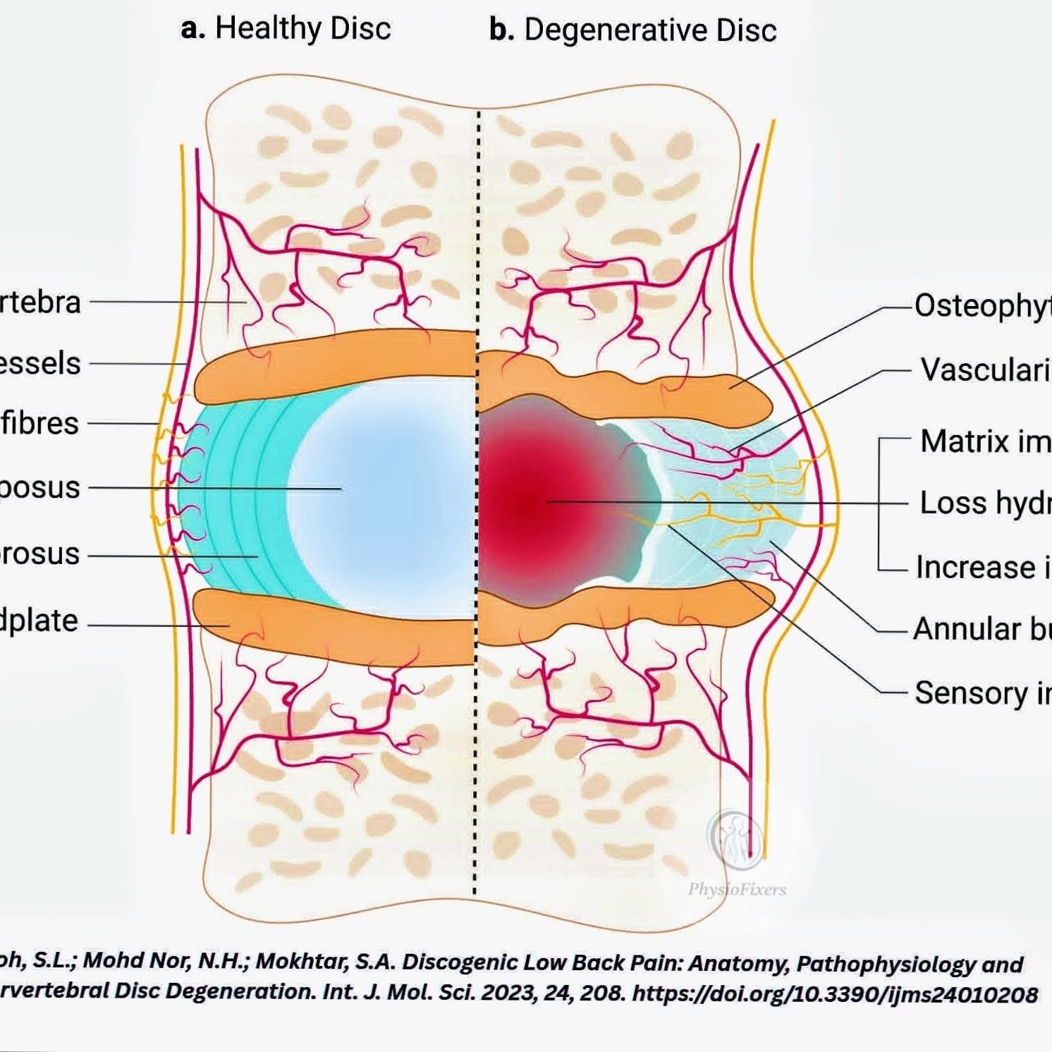 Normal Disc Vs Degenerative Disc, and Physiotherapy Treatment at Sunshine Super Speciality main image