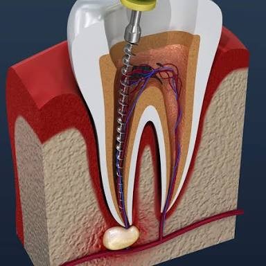 Root canal treatment in Bandra main image