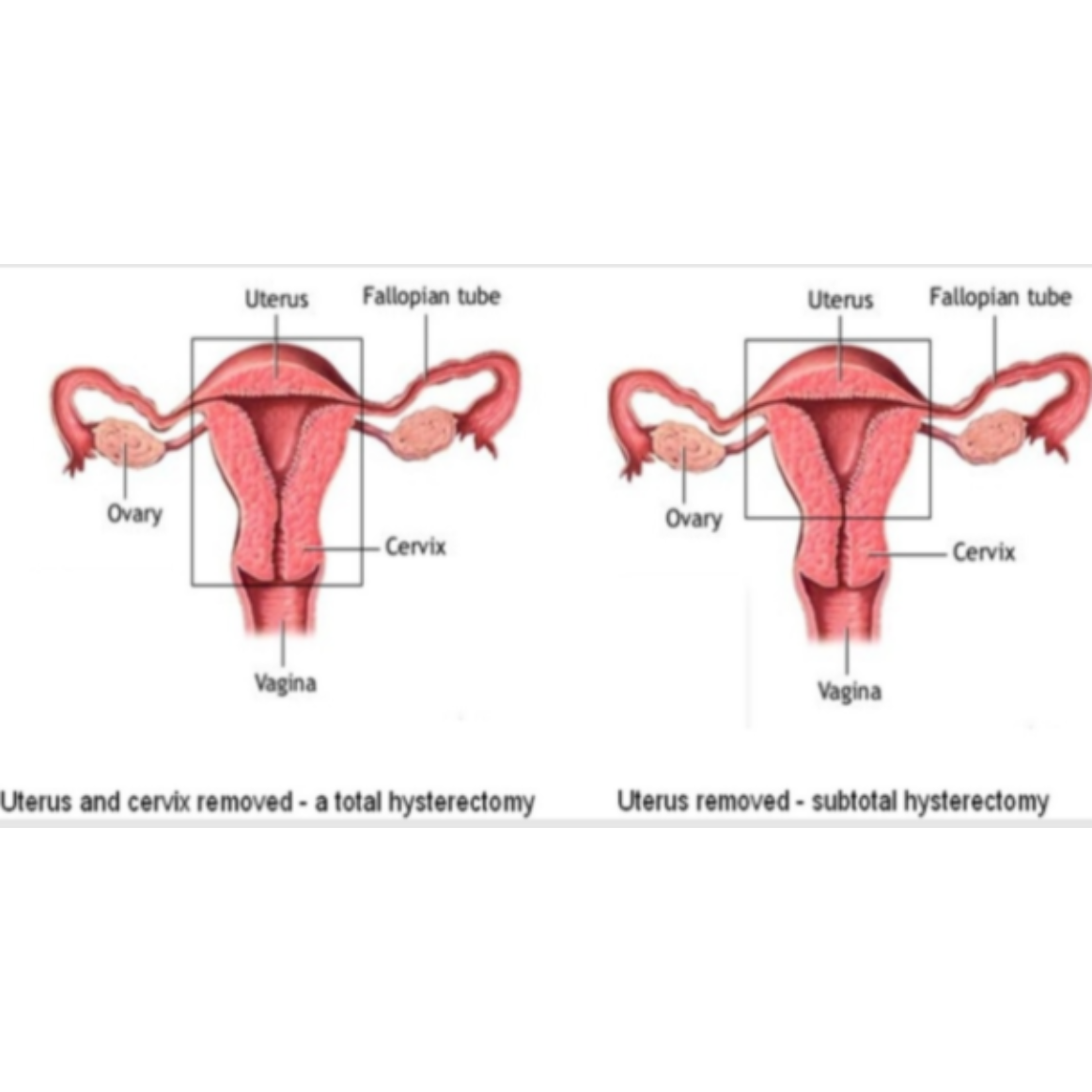 Hysterectomy in Nagpur main image