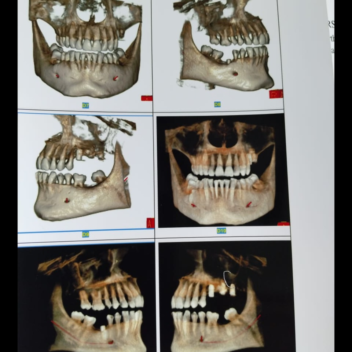CBCT bo