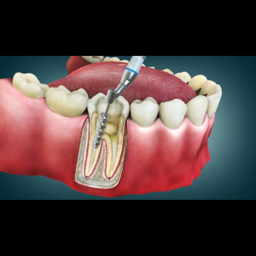 Root Canal treatment in Mahim main image