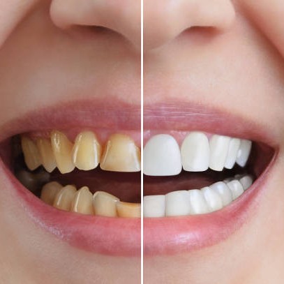 Cosmetic Dentist in Bandra & Mahim main image