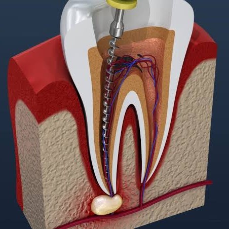 Affordable Root Canal Treatment in Bandra & Mahim main image