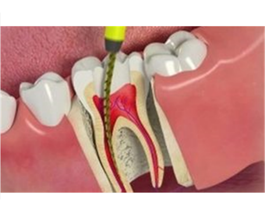 Root Canal Treatments Clinic In Janakpuri main image