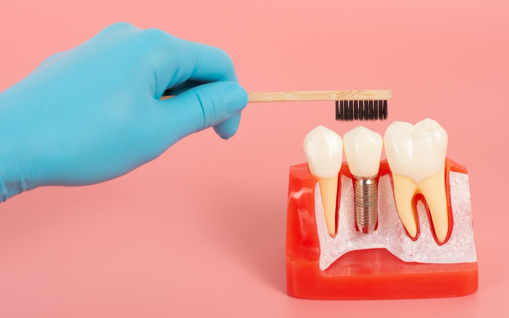  Basal Dental Implants in Delhi – Immediate and Reliable Tooth Replacement main image