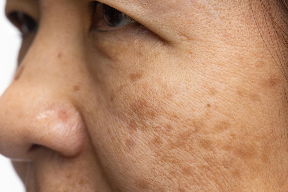 Ayurvedic Treatment for Melasma in Pune – Natural Healing for Even Skin Tone main image