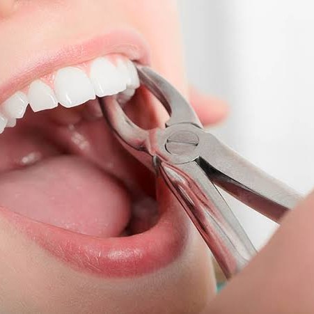 Painless Tooth Extraction in Bandra, Mahim & Dadar – Safe, Gentle & Affordable main image