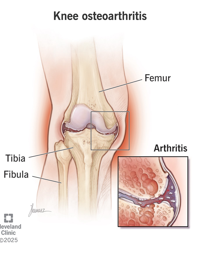 Knee joint pain ,Knee Osteoarthritis Treatment in Mahim & Bandra with home visit facility available  main image