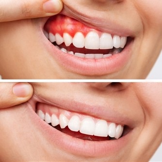 Bleeding Gums? Causes, Treatment & Prevention main image