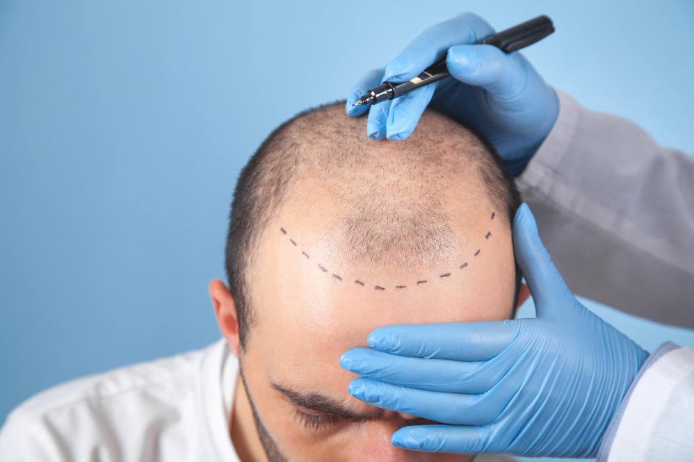 Best Hair Transplant in Chennai – Permanent Solutions for Hair Loss main image