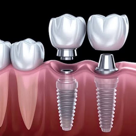 Affordable Dental Implants in Mahim, Bandra & Dadar main image