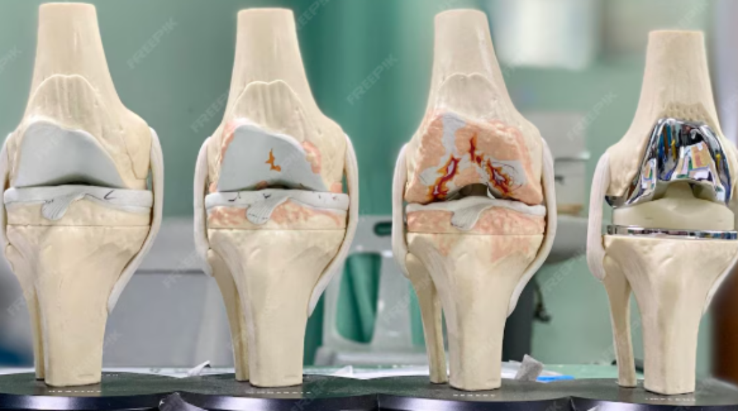 Best Joint Replacement Surgeon In Jaipur – Trusted Orthopedic Guidance main image
