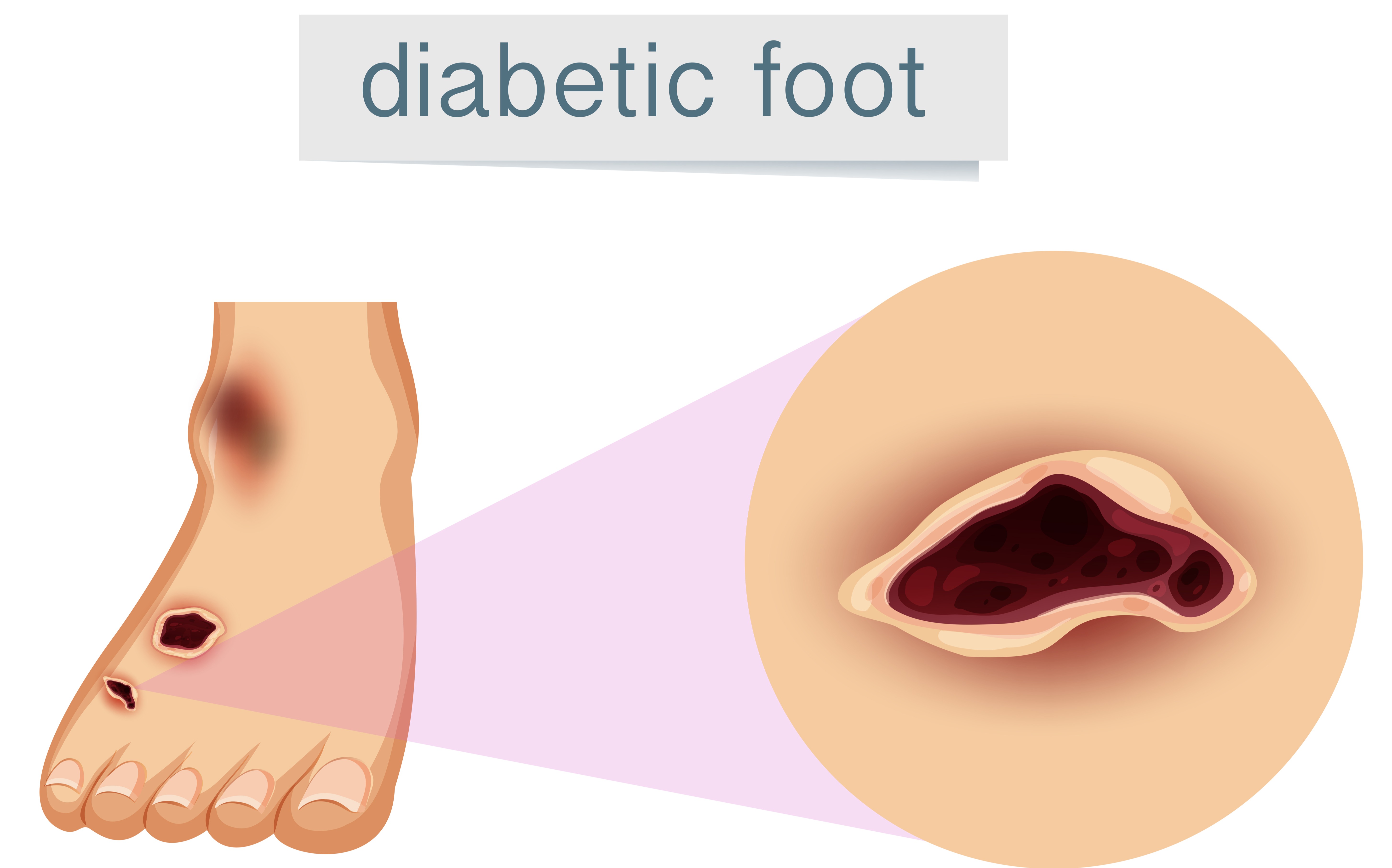 Diabetic foot Treatment in Bangalore – Care That Helps You Walk Confidently Again main image